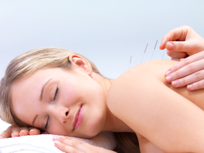 Woman relaxed and receiving acupuncture on her upper back